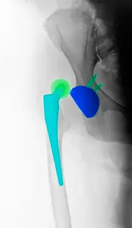 X-ray Showing Hip Dislocation