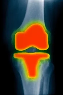 Radiographs Prints: X-ray showing knee replacement hardware