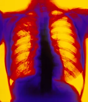 Condition Prints: X-ray showing pulmonary tuberculosis