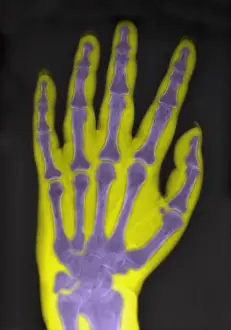 Density Prints: X-Ray Showing Severe Osteoporosis