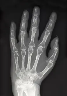 Density Prints: X-Ray Showing Severe Osteoporosis