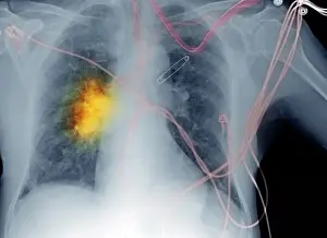 Tumor Prints: X-ray, Smoker's Chest