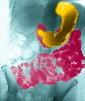 Intestines Prints: X-ray, Stomach & Intestines