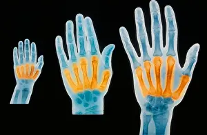 Research Prints: X-rays of 2 year old, 7 year old, and adult