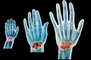 Research Prints: X-rays of 2 year old, 7 year old, and adult